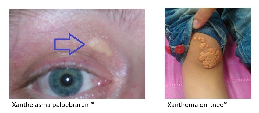Xanthelasma and xanthoma_crop